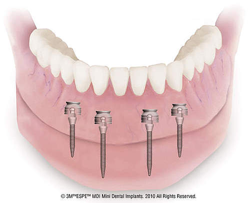 Zahnarzt-Kaempfe_Zahn-Implantate_Implantologie